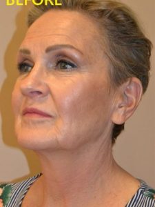 before facelift left angle view of female patient case 73