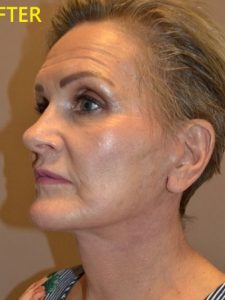 after facelift left angle view of female patient case 73