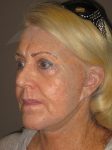 before blepharoplasty left angle view of female patient 1034