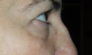 before blepharoplasty right side view of patient 7