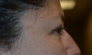 after blepharoplasty right side view of patient 8
