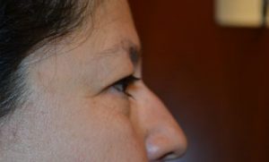 before blepharoplasty right side view of patient 8