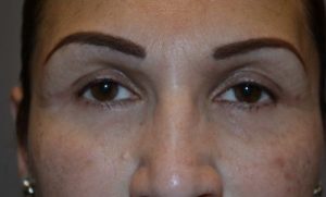 after blepharoplasty front view of patient 9