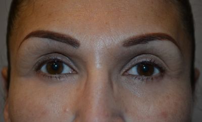 before blepharoplasty front view of patient 9