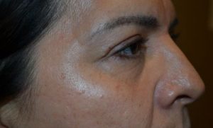 after blepharoplasty right side view of patient 10