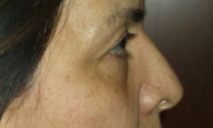 before blepharoplasty right side view of patient 10