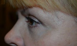 after blepharoplasty left side view of patient 11