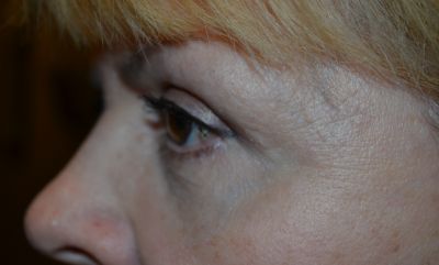 after blepharoplasty left side view of patient 11
