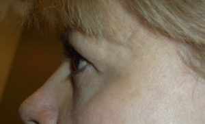 before blepharoplasty left side view of patient 11