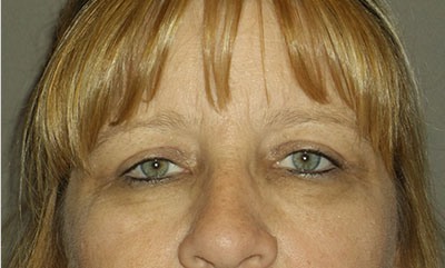 after blepharoplasty front view of patient 1688