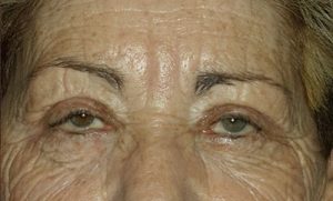 after blepharoplasty front view of patient 1736