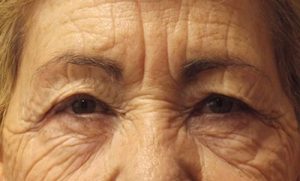 before blepharoplasty front view of patient 1736