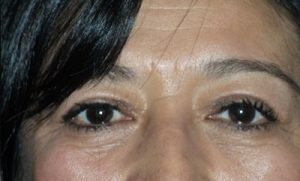 after blepharoplasty front view of patient 1739