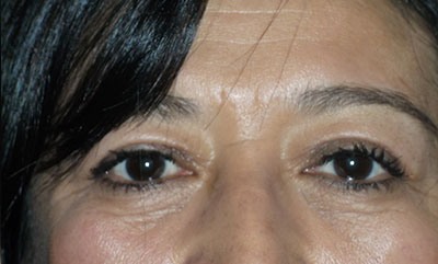 after blepharoplasty front view of patient 1739