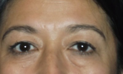 before blepharoplasty front view of patient 1739