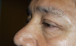 after blepharoplasty left side view of patient 1756