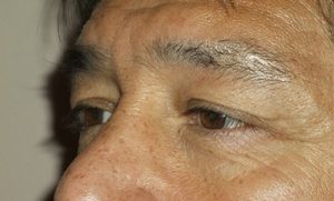 before blepharoplasty left side view of patient 1756