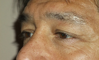 before blepharoplasty left side view of patient 1756
