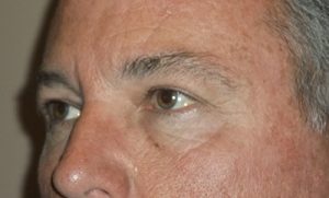 after blepharoplasty left angle side view of patient 1789
