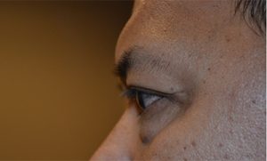 before blepharoplasty left side view of patient 1835