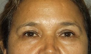 after blepharoplasty front view female patient case 1878