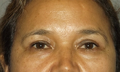 after blepharoplasty front view female patient case 1878