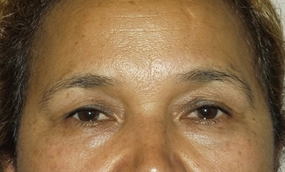 before blepharoplasty front view female patient case 1878