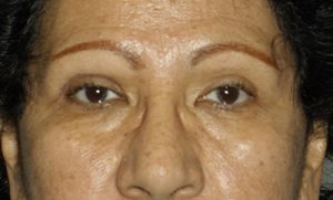 after blepharoplasty front view female patient case 1900