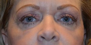 after blepharoplasty front view patient case 1950
