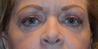 after blepharoplasty front view patient case 1950