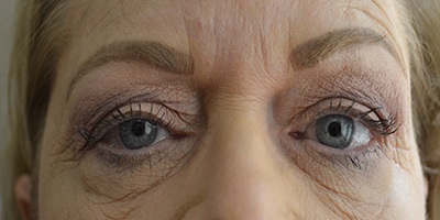 before blepharoplasty front view patient case 1950