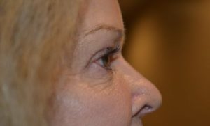 after blepharoplasty right side view female patient case 1990
