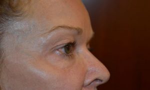 before blepharoplasty right side view female patient case 1990