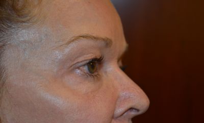 before blepharoplasty right side view female patient case 1990