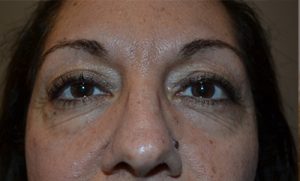 before blepharoplasty front view of patient 23