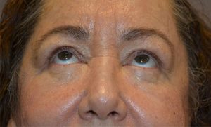 after blepharoplasty front view female patient 24