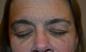 before blepharoplasty front view female patient case 25