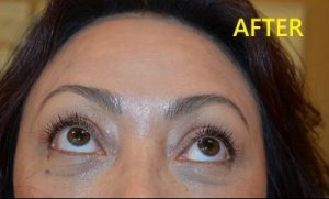after blepharoplasty front view of female patient case 2740