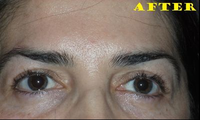 after blepharoplasty front view female patient case 2746
