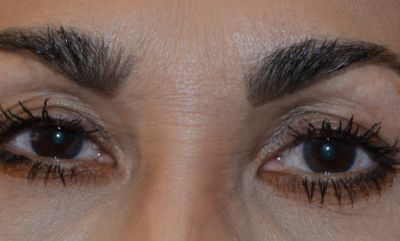 before blepharoplasty front view of female patient case 30