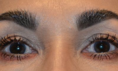 after blepharoplasty front view of female patient case 30