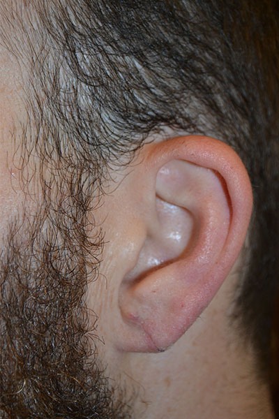 after earlobe repair left angle view patient 1610