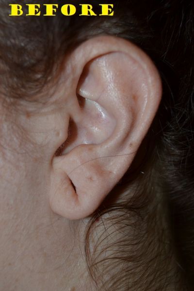 before earlobe repair left view of patient case 2737