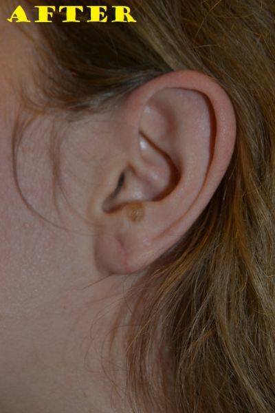 after earlobe repair left view of patient case 2737