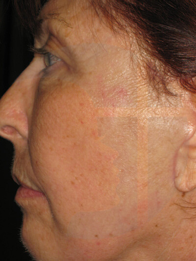 after facelift left side closeup view of female patient 967
