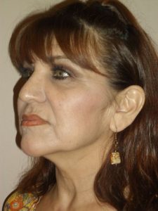 before facelift left angle view of female patient 17