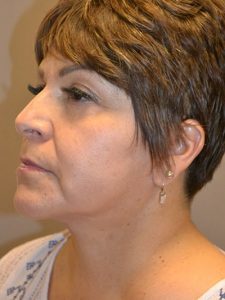 after facelift left angle view of female patient 1638