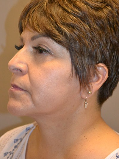 after facelift left angle view of female patient 1638