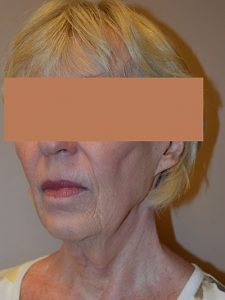before facelift left angle view of female patient 1642