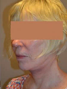 after facelift left angle view of female patient 1642